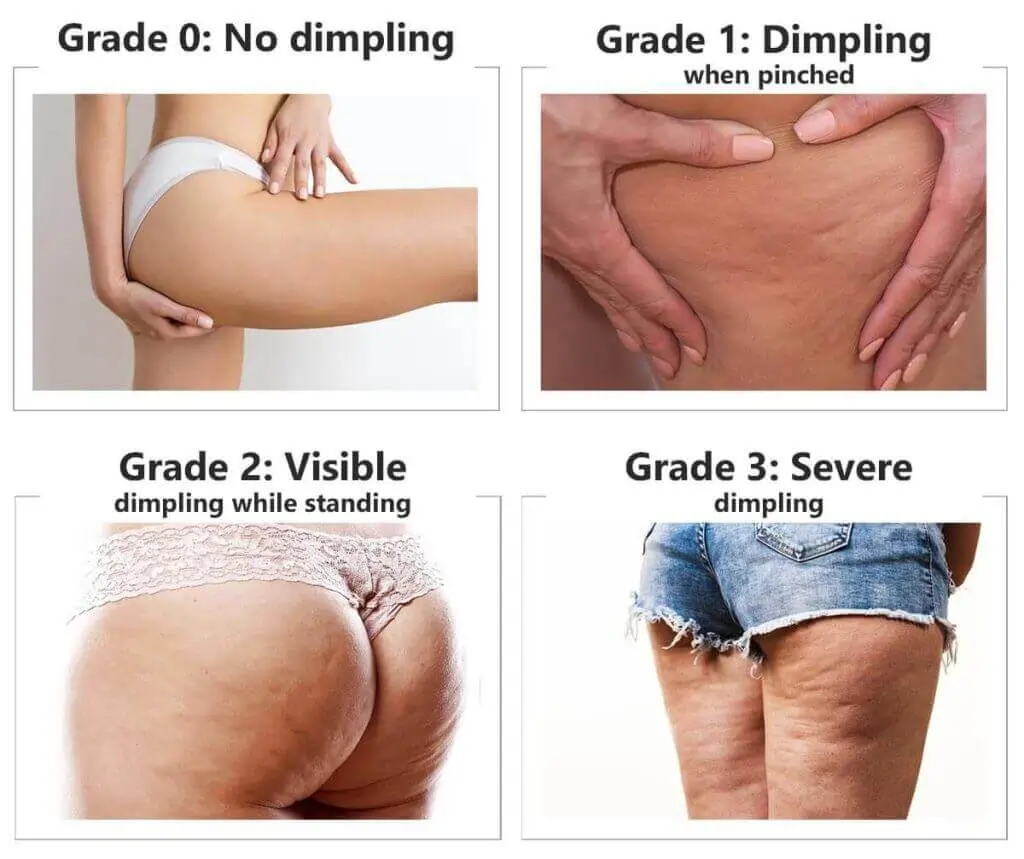 Representation of the stages of cellulite development Hythe